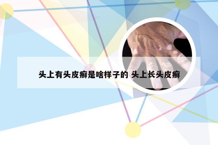 头上有头皮癣是啥样子的 头上长头皮癣