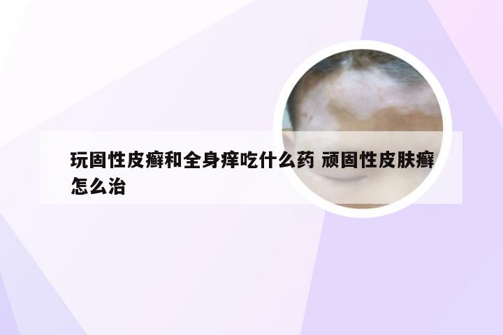 玩固性皮癣和全身痒吃什么药 顽固性皮肤癣怎么治