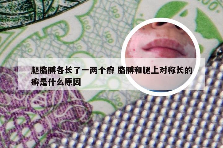腿胳膊各长了一两个癣 胳膊和腿上对称长的癣是什么原因