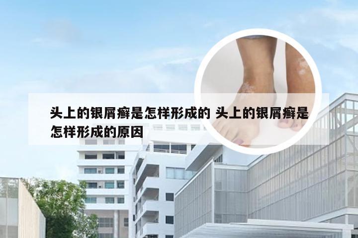 头上的银屑癣是怎样形成的 头上的银屑癣是怎样形成的原因