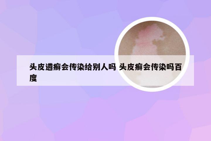 头皮遴癣会传染给别人吗 头皮癣会传染吗百度