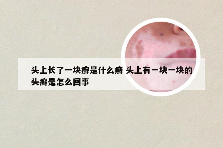 头上长了一块癣是什么癣 头上有一块一块的头癣是怎么回事