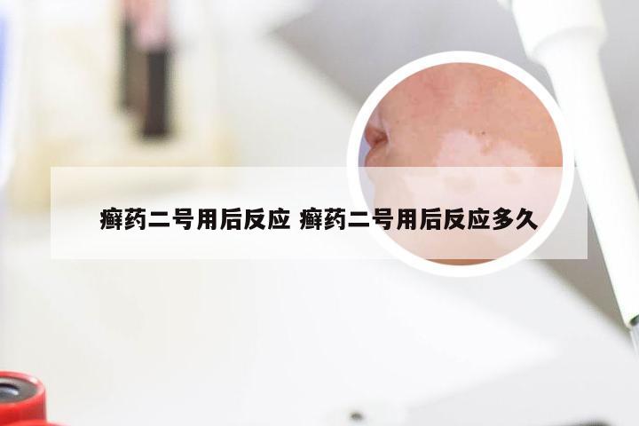 癣药二号用后反应 癣药二号用后反应多久