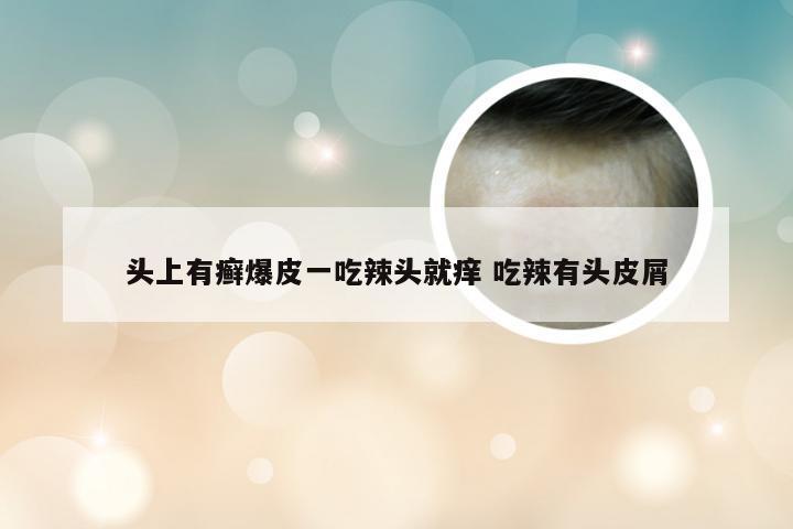 头上有癣爆皮一吃辣头就痒 吃辣有头皮屑