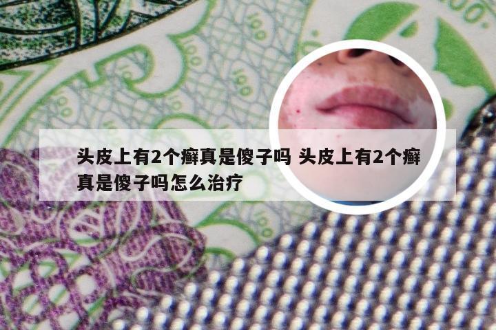 头皮上有2个癣真是傻子吗 头皮上有2个癣真是傻子吗怎么治疗