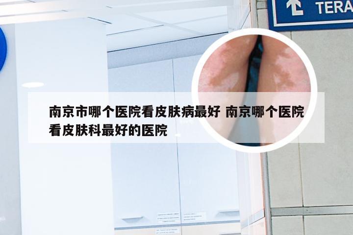 南京市哪个医院看皮肤病最好 南京哪个医院看皮肤科最好的医院