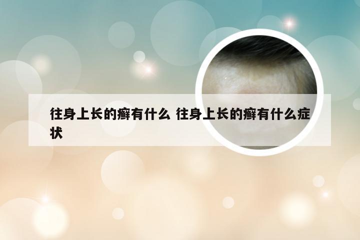 往身上长的癣有什么 往身上长的癣有什么症状