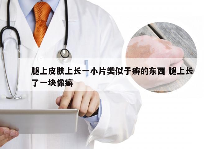 腿上皮肤上长一小片类似于癣的东西 腿上长了一块像癣