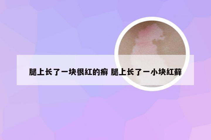 腿上长了一块很红的癣 腿上长了一小块红藓
