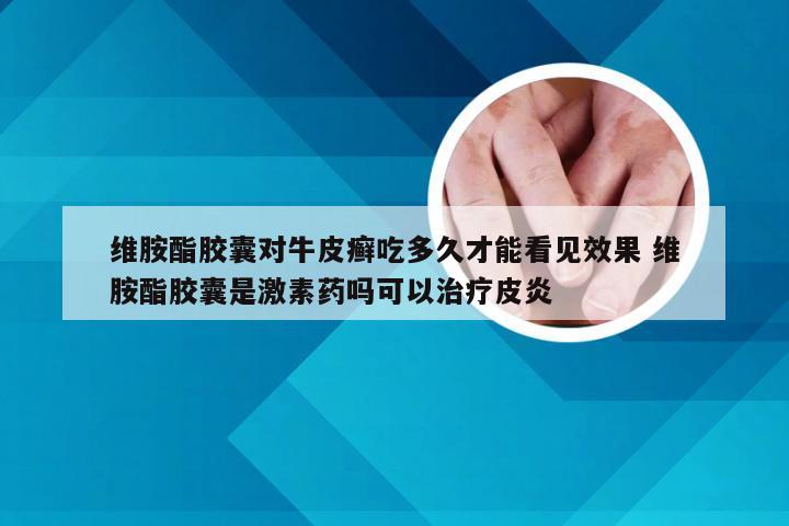 维胺酯胶囊对牛皮癣吃多久才能看见效果 维胺酯胶囊是激素药吗可以治疗皮炎