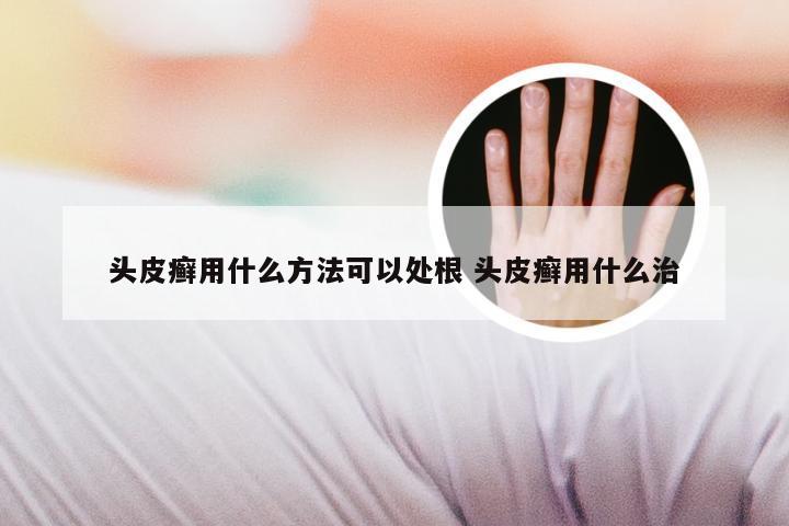 头皮癣用什么方法可以处根 头皮癣用什么治