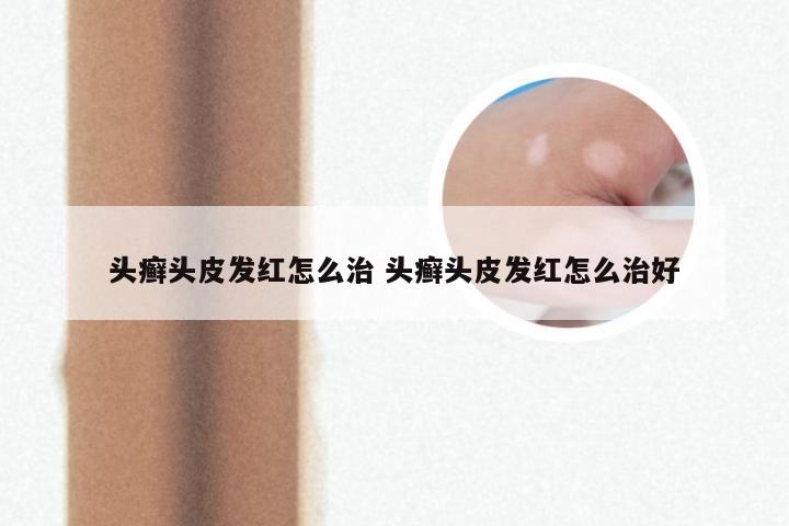 头癣头皮发红怎么治 头癣头皮发红怎么治好