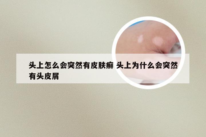 头上怎么会突然有皮肤癣 头上为什么会突然有头皮屑