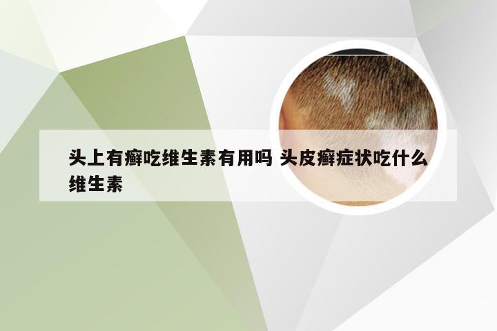 头上有癣吃维生素有用吗 头皮癣症状吃什么维生素