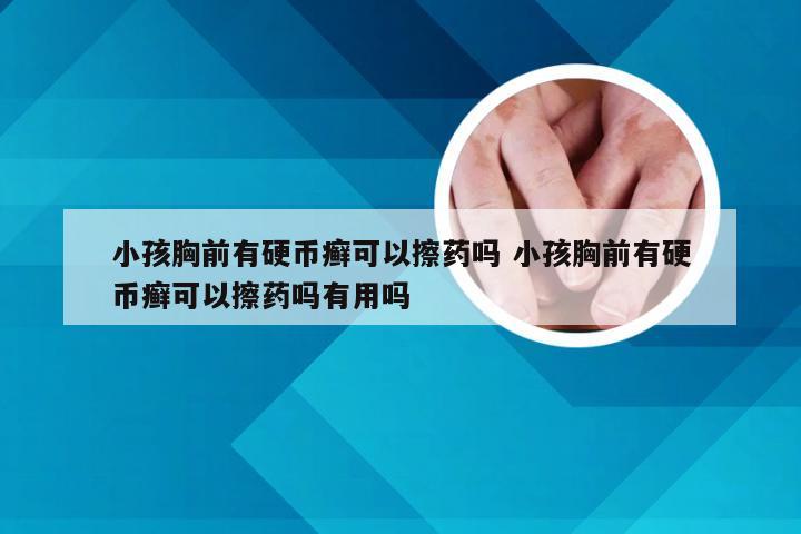 小孩胸前有硬币癣可以擦药吗 小孩胸前有硬币癣可以擦药吗有用吗