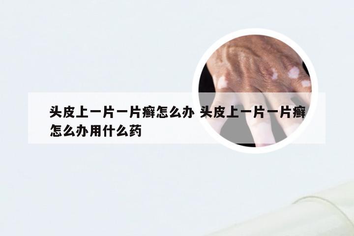 头皮上一片一片癣怎么办 头皮上一片一片癣怎么办用什么药