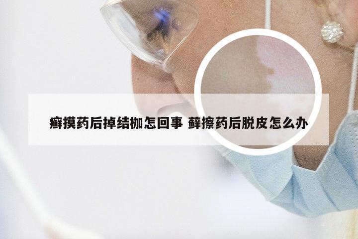 癣摸药后掉结枷怎回事 藓擦药后脱皮怎么办