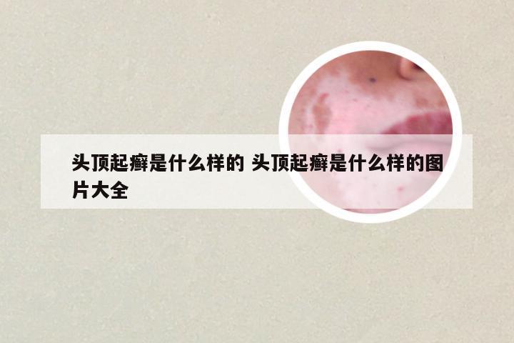 头顶起癣是什么样的 头顶起癣是什么样的图片大全