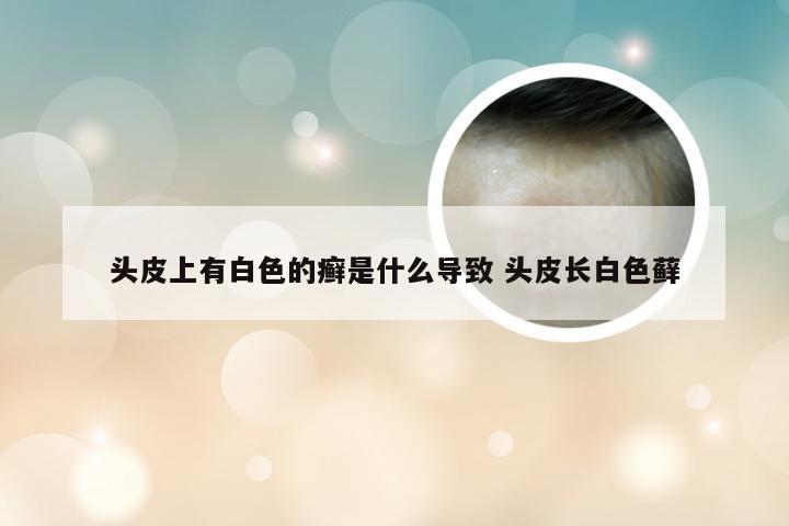 头皮上有白色的癣是什么导致 头皮长白色藓