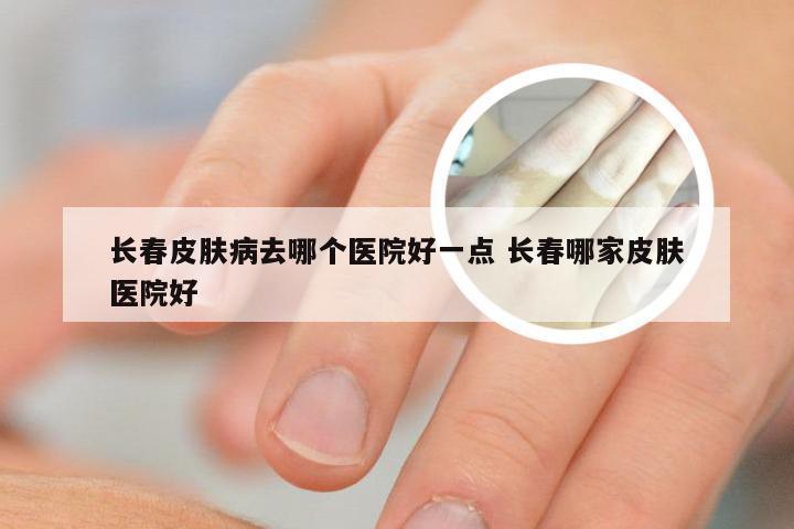 长春皮肤病去哪个医院好一点 长春哪家皮肤医院好
