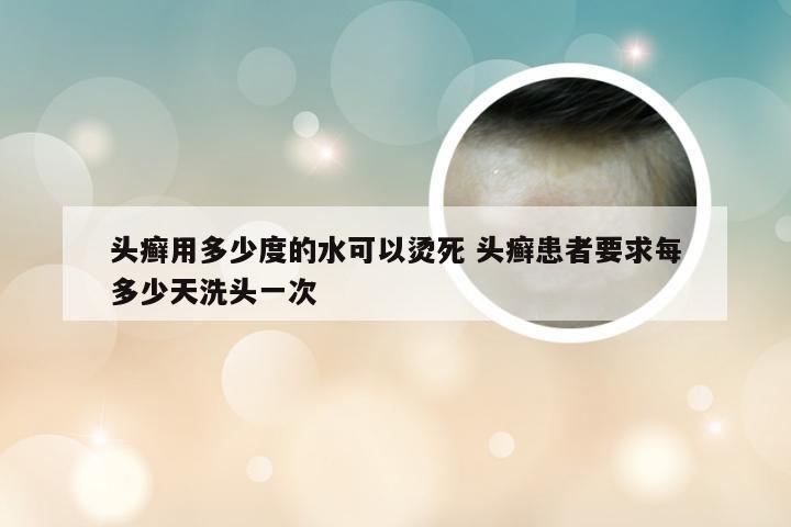 头癣用多少度的水可以烫死 头癣患者要求每多少天洗头一次