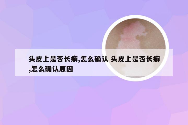 头皮上是否长癣,怎么确认 头皮上是否长癣,怎么确认原因