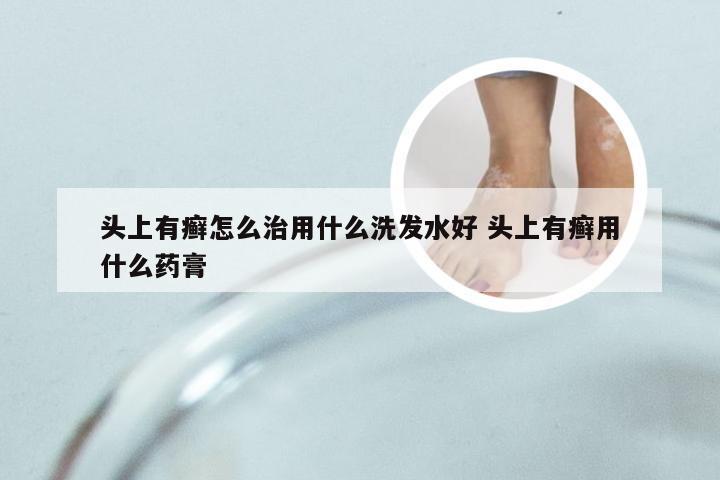 头上有癣怎么治用什么洗发水好 头上有癣用什么药膏