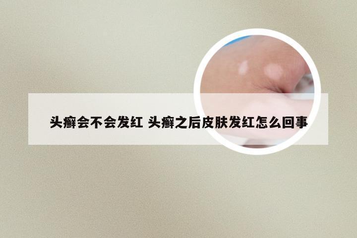 头癣会不会发红 头癣之后皮肤发红怎么回事