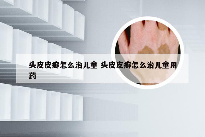头皮皮癣怎么治儿童 头皮皮癣怎么治儿童用药