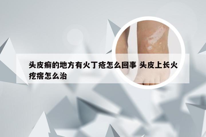 头皮癣的地方有火丁疮怎么回事 头皮上长火疙瘩怎么治