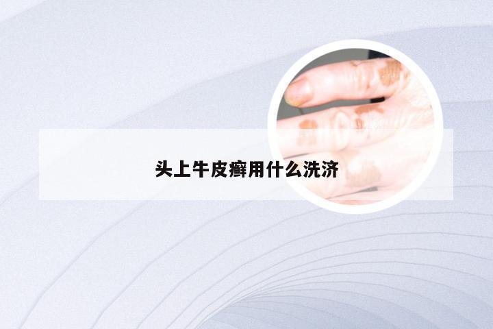 头上牛皮癣用什么洗济