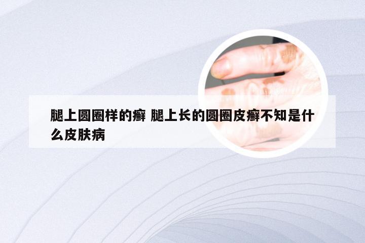 腿上圆圈样的癣 腿上长的圆圈皮癣不知是什么皮肤病