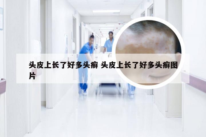 头皮上长了好多头癣 头皮上长了好多头癣图片
