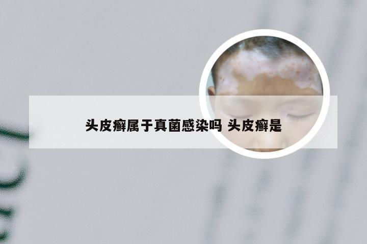 头皮癣属于真菌感染吗 头皮癣是