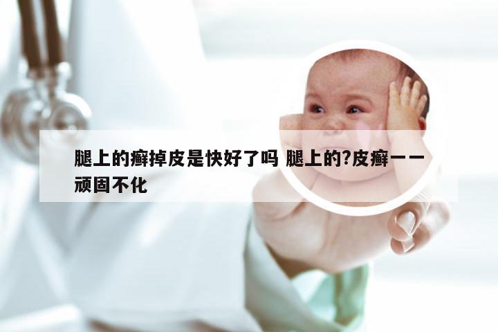 腿上的癣掉皮是快好了吗 腿上的?皮癣一一顽固不化
