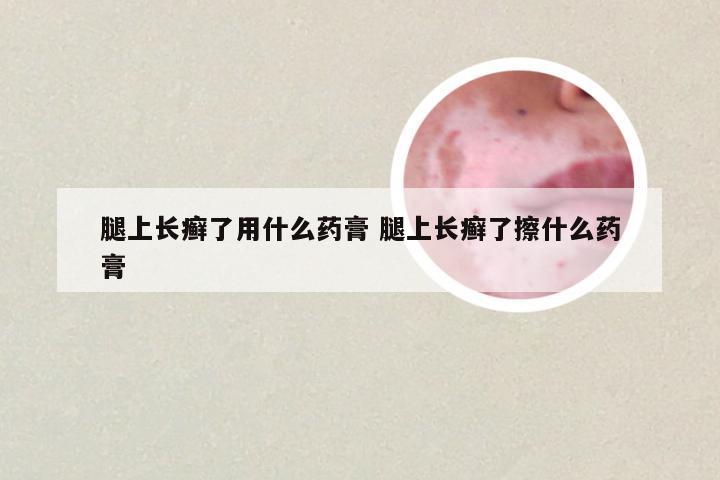 腿上长癣了用什么药膏 腿上长癣了擦什么药膏