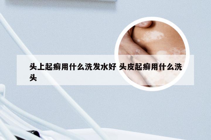 头上起癣用什么洗发水好 头皮起癣用什么洗头
