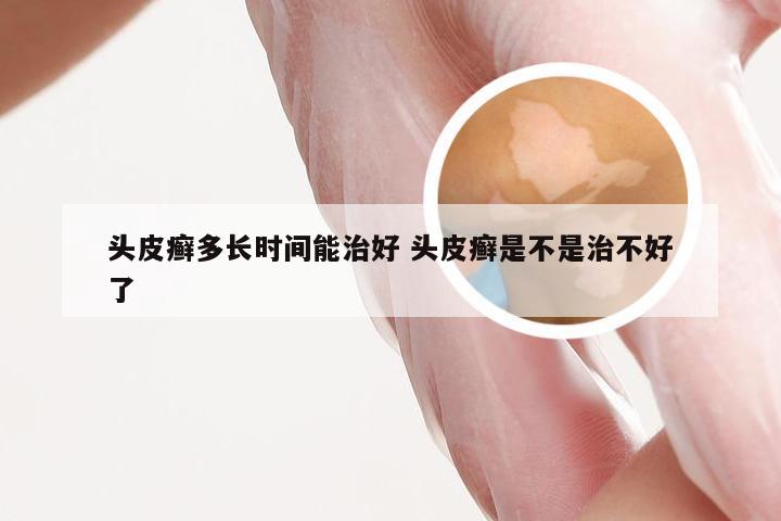 头皮癣多长时间能治好 头皮癣是不是治不好了
