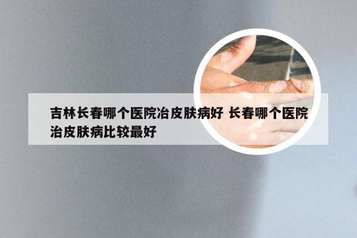 吉林长春哪个医院冶皮肤病好 长春哪个医院治皮肤病比较最好