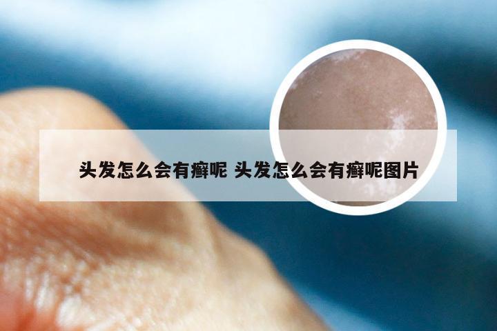 头发怎么会有癣呢 头发怎么会有癣呢图片