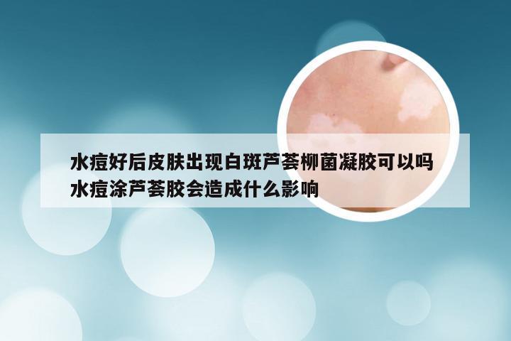 水痘好后皮肤出现白斑芦荟柳菌凝胶可以吗 水痘涂芦荟胶会造成什么影响