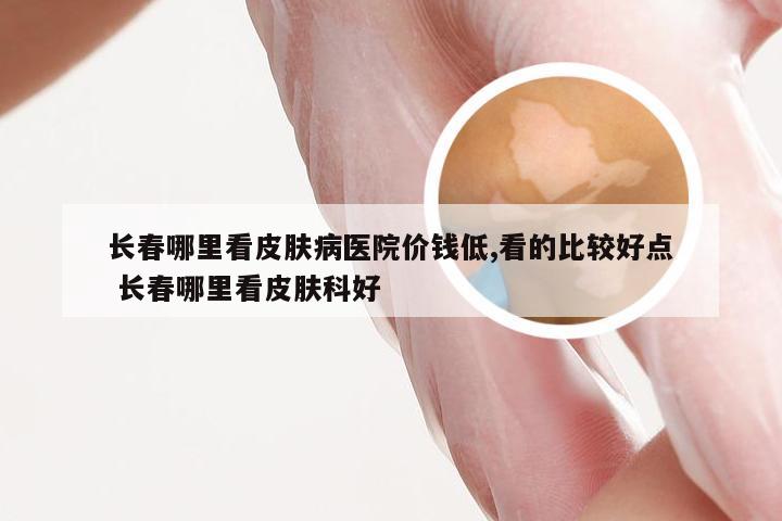 长春哪里看皮肤病医院价钱低,看的比较好点 长春哪里看皮肤科好