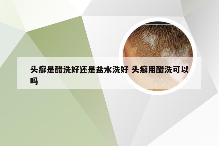 头癣是醋洗好还是盐水洗好 头癣用醋洗可以吗