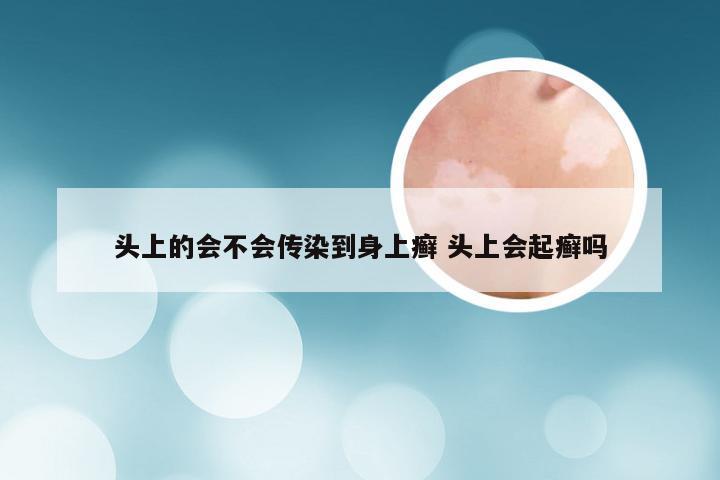 头上的会不会传染到身上癣 头上会起癣吗