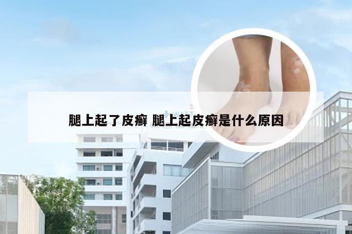 腿上起了皮癣 腿上起皮癣是什么原因