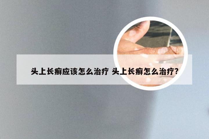 头上长癣应该怎么治疗 头上长癣怎么治疗?