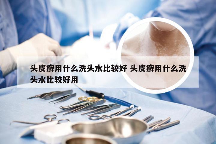 头皮癣用什么洗头水比较好 头皮癣用什么洗头水比较好用