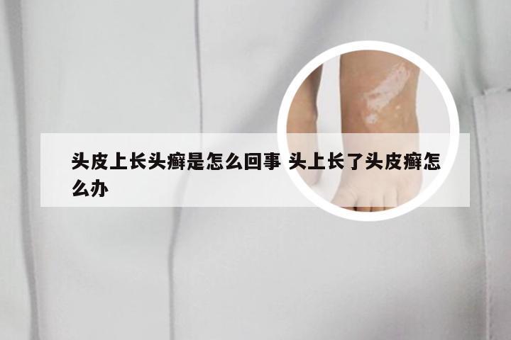 头皮上长头癣是怎么回事 头上长了头皮癣怎么办