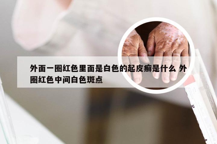 外面一圈红色里面是白色的起皮癣是什么 外圈红色中间白色斑点