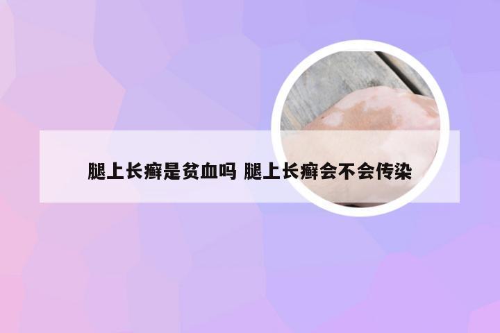 腿上长癣是贫血吗 腿上长癣会不会传染